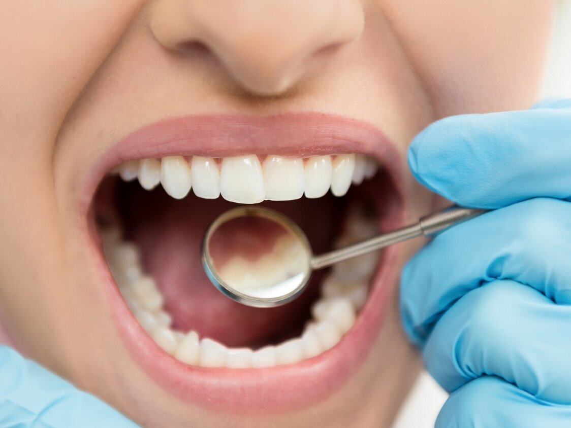 Frau mit geöffnetem Mund beim Zahnarzt.