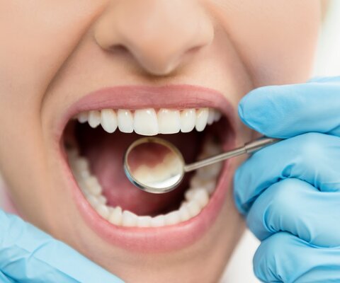 Frau mit geöffnetem Mund beim Zahnarzt.