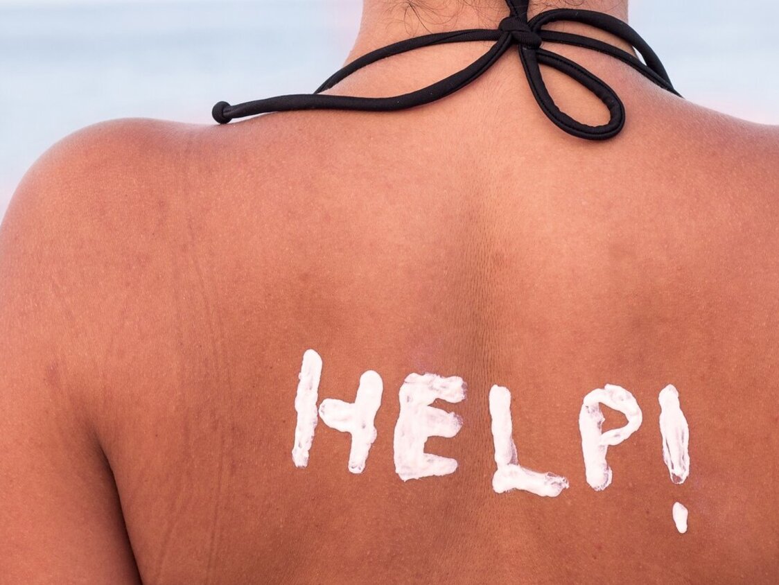 Eine Frau hat Sonnenbrand auf dem Rücken. Mit Sonnencreme wurde "HELP!" auf ihren Rücken geschrieben.