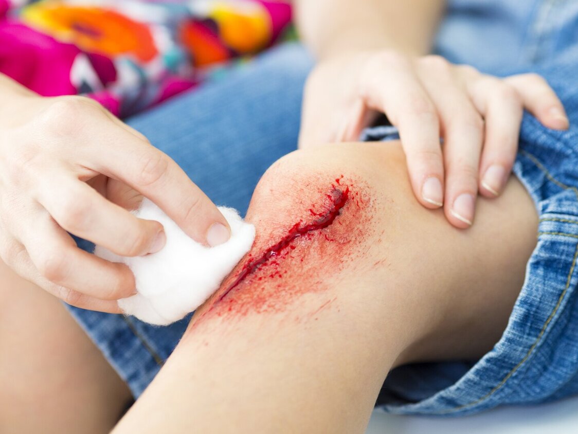 Jemand säubert mit einem Tupfer die blutende Kniewunde eines Kindes.