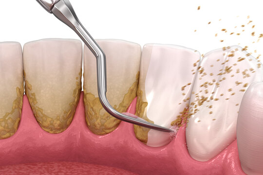 Oral,Hygiene:,Scaling,And,Root,Planing,(conventional,Periodontal,Therapy).,Medically
