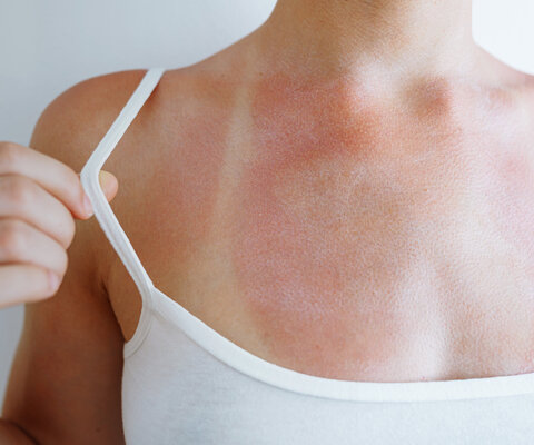 Sonnenbrand auf der Haut mit Spuren von Badeanzug