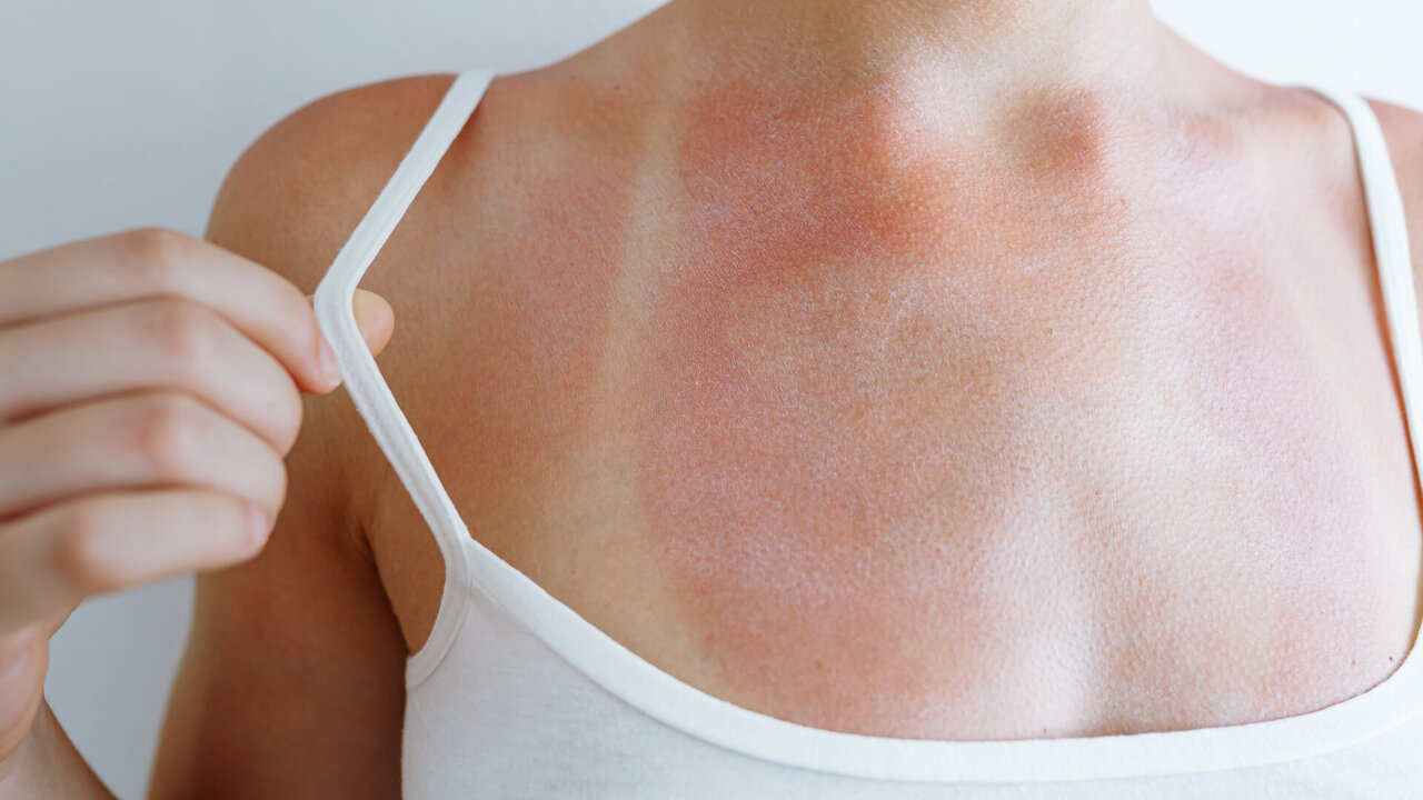 Sonnenallergie (Polymorphe Lichtdermatose): Symptome, Behandlung und Schutz  - hkk Magazin