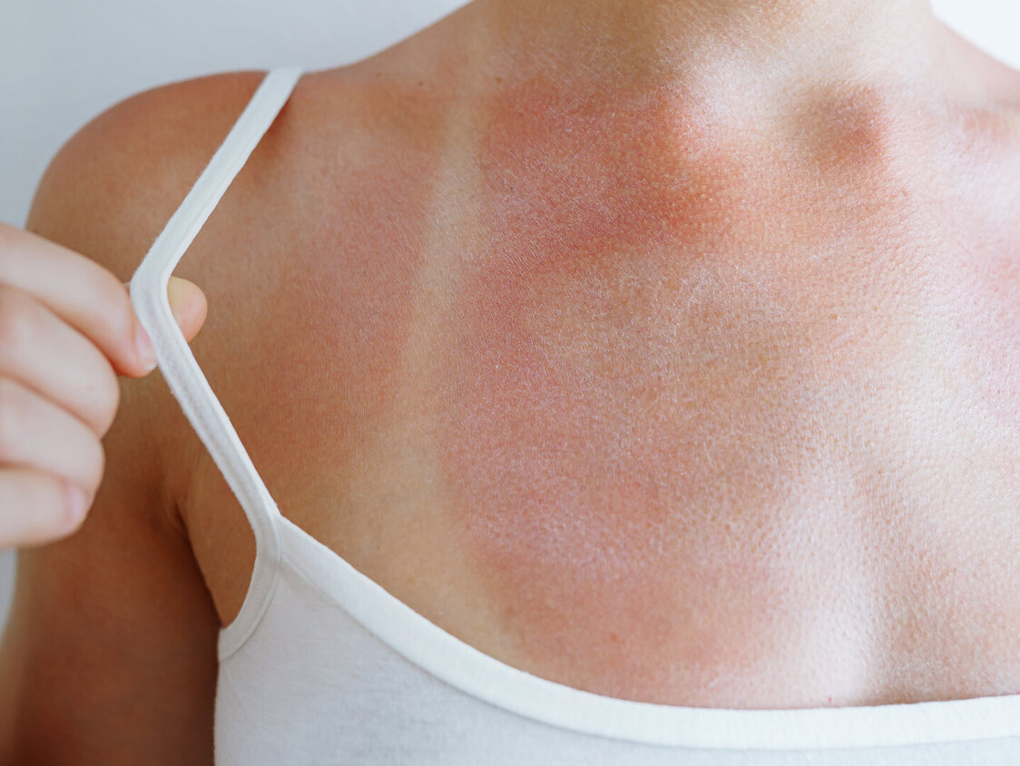 Sonnenbrand auf der Haut mit Spuren von Badeanzug
