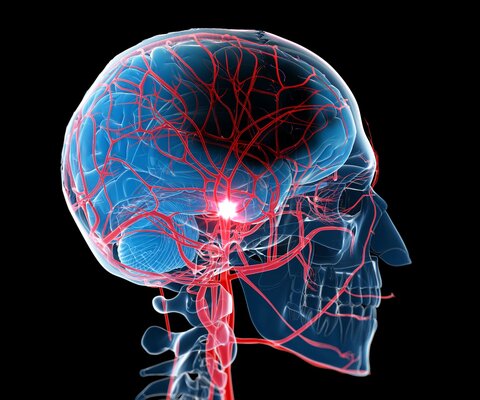 Der Kopf wird durchsichtig mit den Gefäßen dargestellt und man kann einen Schlaganfall erkennen.