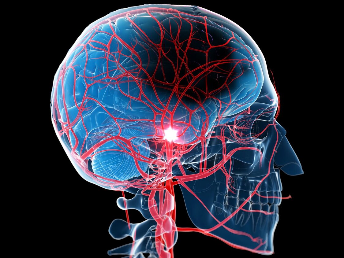 Der Kopf wird durchsichtig mit den Gefäßen dargestellt und man kann einen Schlaganfall erkennen.