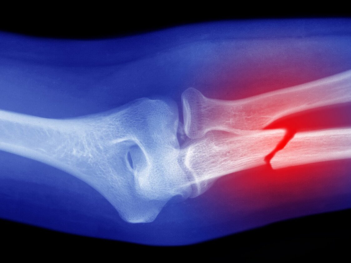 Ein Röntgenbild einen gebrochenen Arms