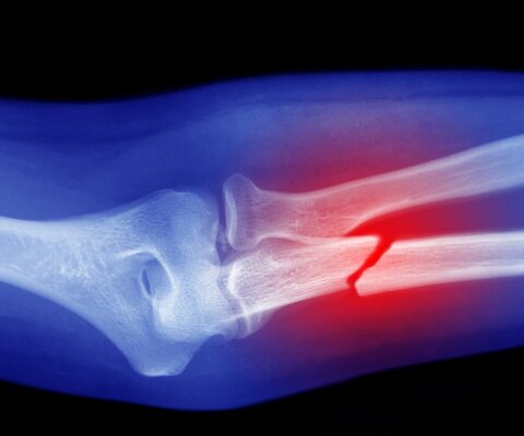 Ein Röntgenbild einen gebrochenen Arms