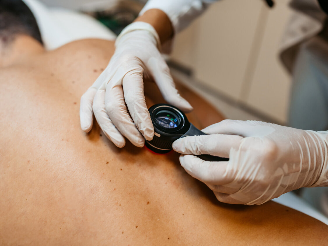 Eine Mann in einer Hautkrebsuntersuchung durch einen Arzt mit Lupe