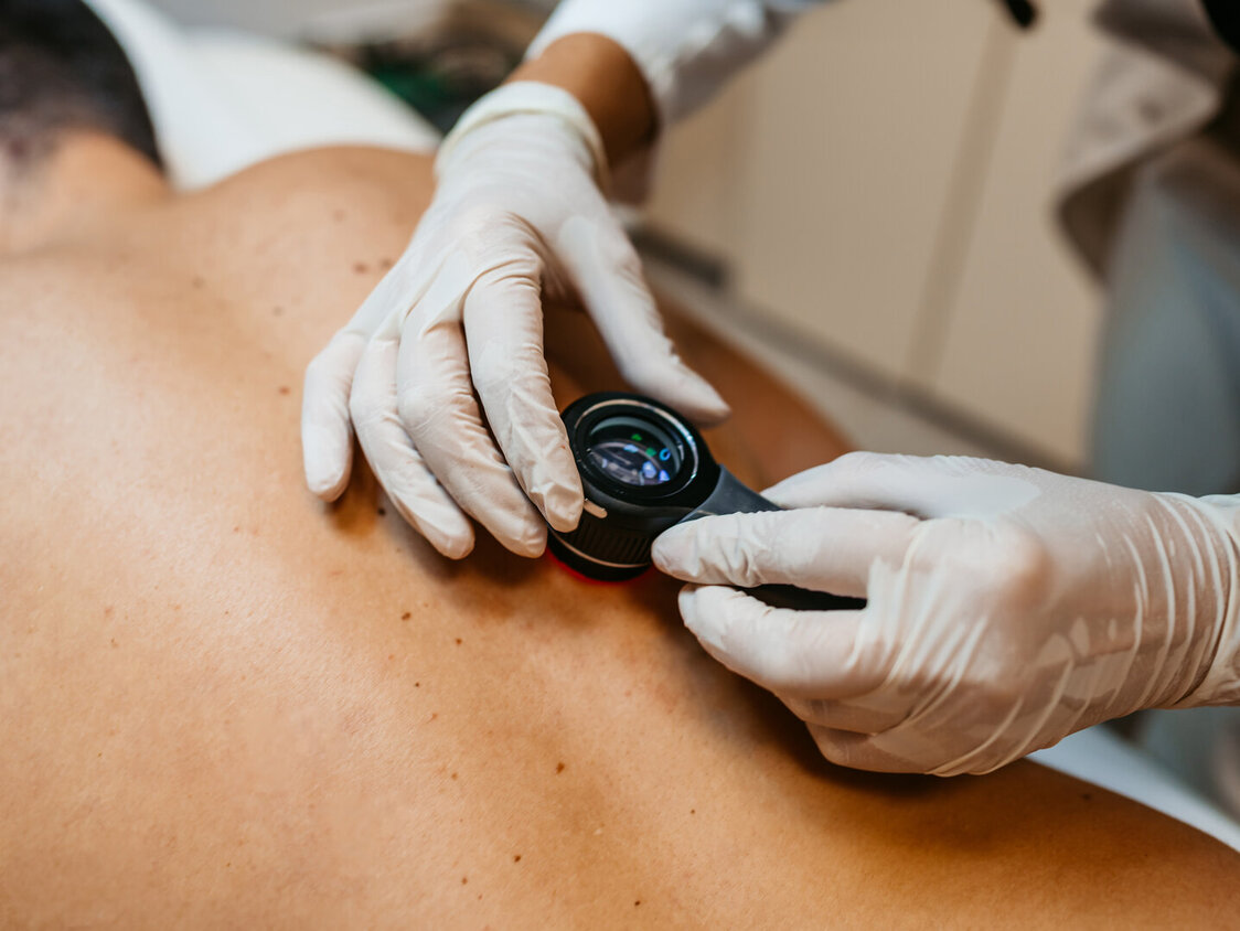 Eine Mann in einer Hautkrebsuntersuchung durch einen Arzt mit Lupe