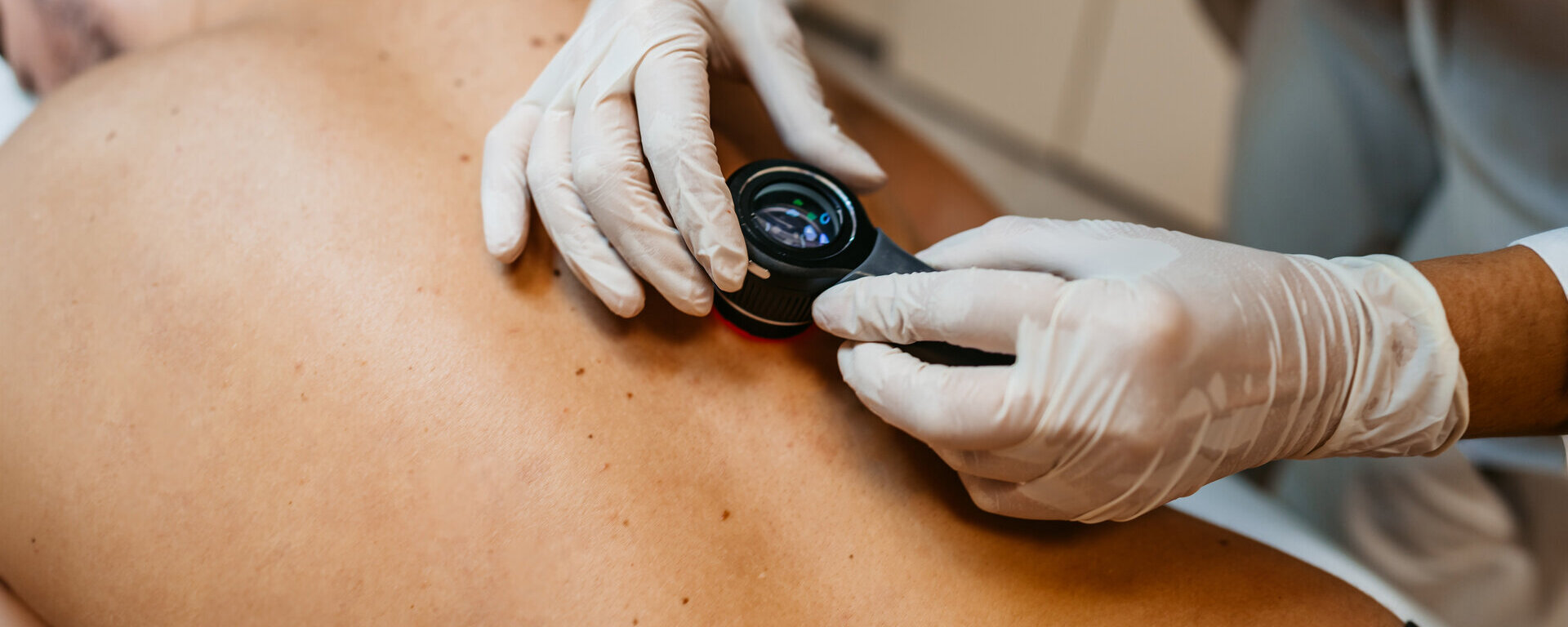 Eine Mann in einer Hautkrebsuntersuchung durch einen Arzt mit Lupe