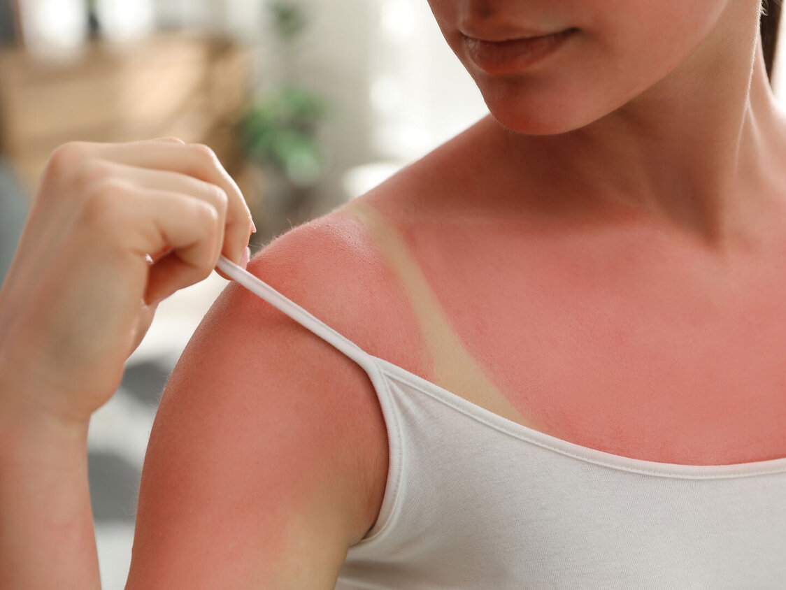 Eine Frau mit Sonnenbrand am Oberkörper. Sie zieht den Träger ihres Tops zur Seite, darunter ist ein weißer Abdruck.
