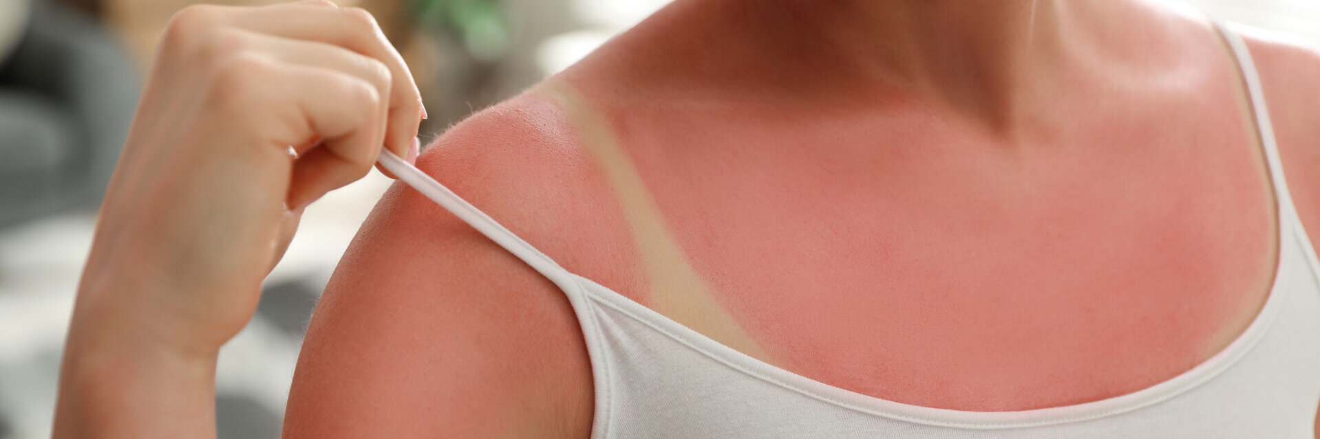 Eine Frau mit Sonnenbrand am Oberkörper. Sie zieht den Träger ihres Tops zur Seite, darunter ist ein weißer Abdruck.
