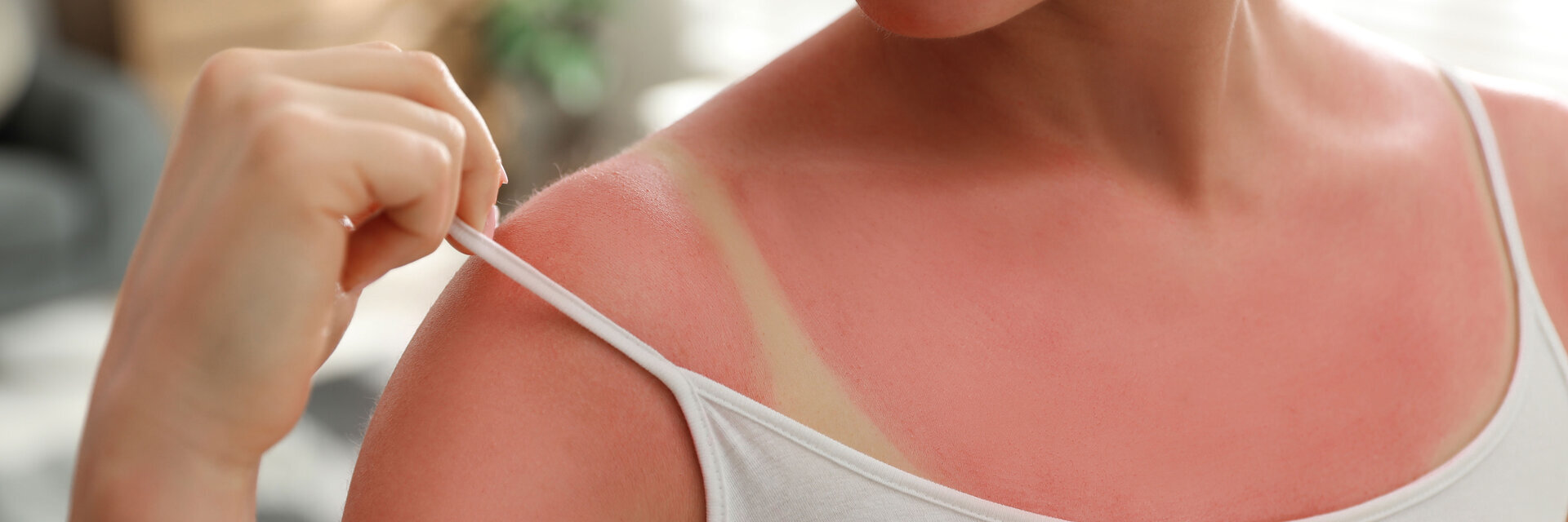 Eine Frau mit Sonnenbrand am Oberkörper. Sie zieht den Träger ihres Tops zur Seite, darunter ist ein weißer Abdruck.