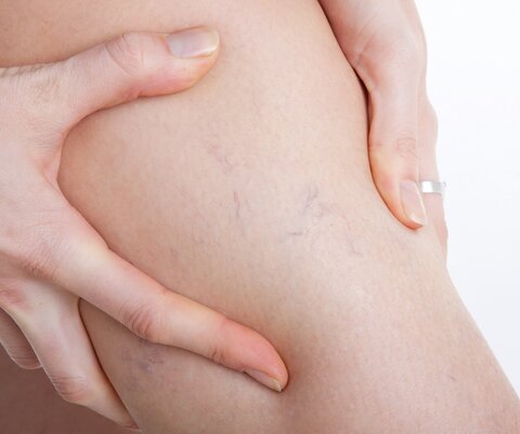 Ein nacktes Bein wird festgehalten und man kann die Adern sehen.